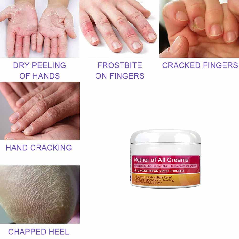 Body Cream Body Moisturizer Für Trockene Juckende Und Empfindliche Haut, Gesicht Oder Körper, Hautpflege Für Rötungen Und Trockenheit
