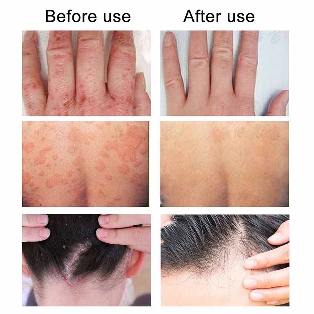 Body Cream Body Moisturizer Für Trockene Juckende Und Empfindliche Haut, Gesicht Oder Körper, Hautpflege Für Rötungen Und Trockenheit