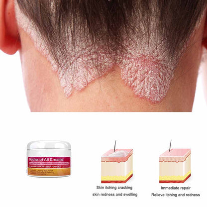Body Cream Body Moisturizer Für Trockene Juckende Und Empfindliche Haut, Gesicht Oder Körper, Hautpflege Für Rötungen Und Trockenheit